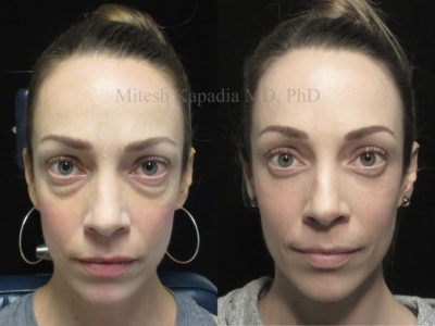 Woman in her 30s before and after lower eyelid surgery, showing the reduction of undereye bags and puffiness, leaving her appearing refreshed and youthful