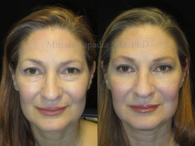 Woman in her mid-50s before and after upper and lower eyelid surgery, revealing a well rested, more youthful and natural appearance