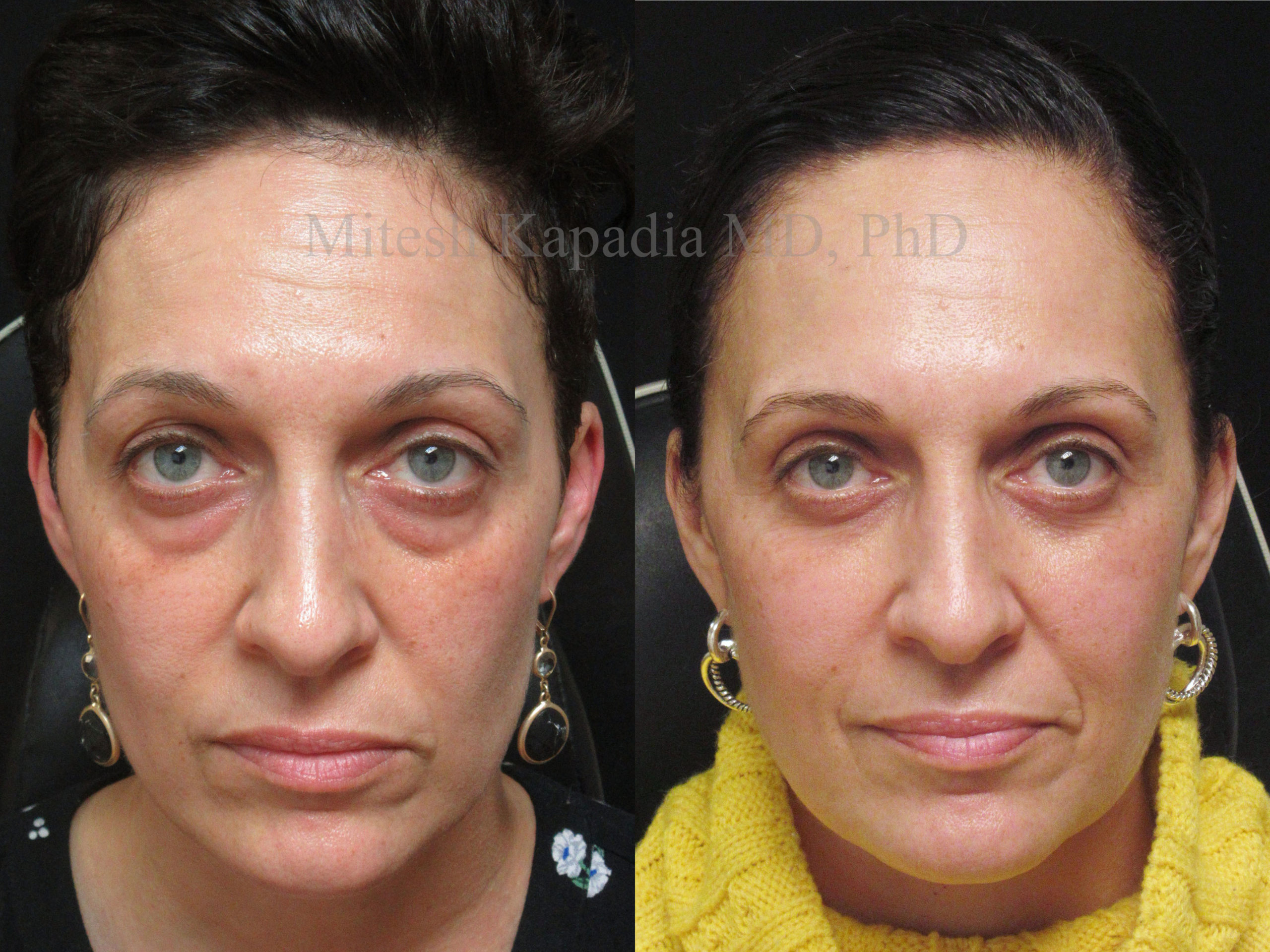 Patient 1 - Before and seven months after lower blepharoplasty surgery.