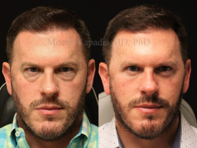 Man in his mid-40s before and after upper and lower eyelid surgery, revealing a less tired, and refreshed appearance
