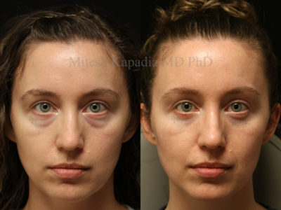 Woman in her mid-30s before and after lower eyelid surgery and midface fillers, showing a vibrant, less tired look