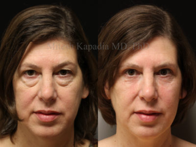 Woman in her late 50s before and three months after upper and lower eyelid surgery, as well as lower eyelid CO2 laser resurfacing, giving her a more youthful, less tired and rejuvenated appearance