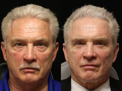 Man in 60s looks younger and more awake after upper and lower eyelid surgery.