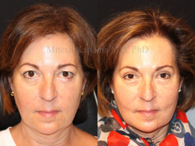 Woman in her early 60s before and six months after upper eyelid surgery, giving her a more youthful, refreshed look