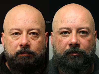 Man in his mid-40s before and after upper and lower eyelid surgery with ptosis repair, as well as midface fillers. Opening his eyes and removing the undereye bags gives him a more youthful, and less tired appearance while still maintaining a masculine look