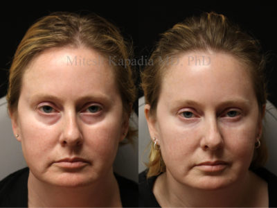 Woman in her early 40s before and after lower eyelid filler injections, showing a great reduction in undereye hollowing, giving her a well rested appearance