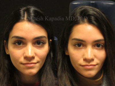 Woman in her late 20s before and after lower eyelid filler injections, displaying a well rested, refreshed look
