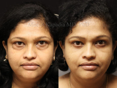 Woman in her late 40s before and after lower eyelid surgery revealing a softer, more youthful appearance