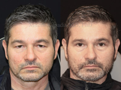 Man in his mid-50s before and after upper eyelid surgery, showing a rejuvenated, more youthful appearance, while still looking natural