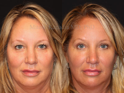 Woman in her early 50s before and after upper eyelid surgery, revealing a refreshed, less tired and natural appearance