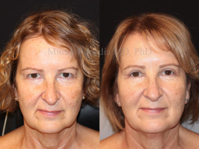 Woman in her early 60s before and after upper eyelid surgery, revealing a rejuvenated and more youthful look