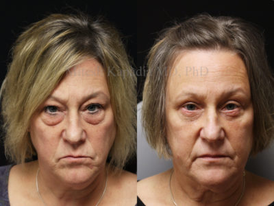 Woman in her early 50s before and after upper and lower eyelid surgery, showing a rejuvenated and more youthful appearance