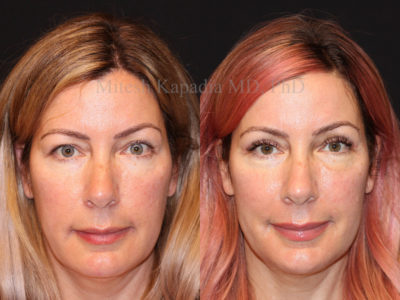 Woman in her late 40s before and after upper eyelid surgery, revealing a more awake, refreshed and vibrant appearance