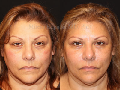 Woman in her late 50s before and after upper eyelid surgery with ptosis repair on the right eye. This patient appears more youthful and symmetrical after her procedure