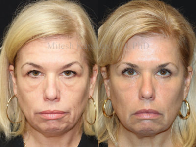 Woman in her early 50s before and after upper and lower eyelid surgery, leaving her with a refreshed, more youthful, and less tired look