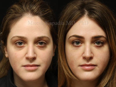 Woman in her early 30s before and after lower eyelid filler injections to reduce volume loss causing dark circles under the eyes. This patient appears well rested and refreshed after her procedure
