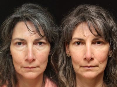 Woman in her mid-50s before and after upper and lower eyelid surgery, displaying a less tired, more youthful appearance