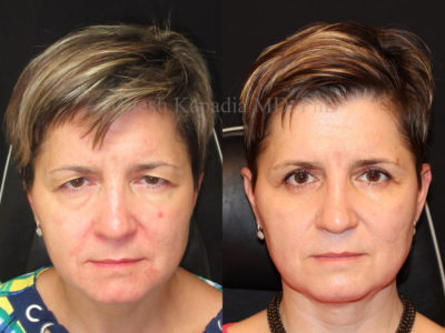 Woman in her mid-40s before and after upper and lower eyelid surgery, displaying a more youthful, well rested and happier appearance