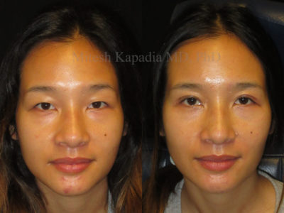 Woman in her late 20s before and after Asian eyelid surgery, revealing the appearance of larger eyes and a refreshed look
