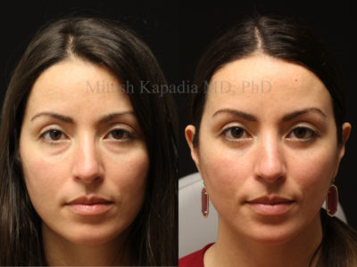 Woman in her mid-30s before and after lower eyelid surgery, showing diminished undereye bags, giving her a refreshed and less tired appearance