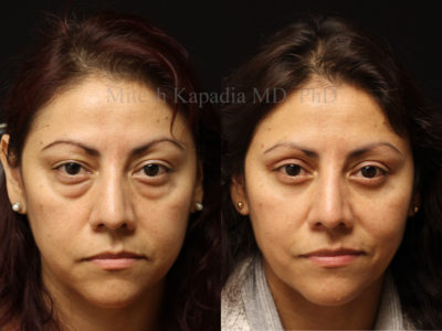 Woman in her mid-40s before and after upper and lower eyelid surgery, showing a refreshed and radiant appearance
