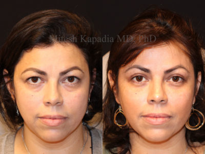Woman in her late 40s before and after upper and lower eyelid surgery with lower eyelid filler added during the postoperative period. This patient appears more youthful and less tired after these procedures