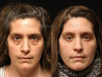 Woman in her mid-40s before and after lower eyelid surgery, as well as filler injections to the undereye area done during the postoperative period. This patient displays a more youthful, refreshed appearance while still looking natural