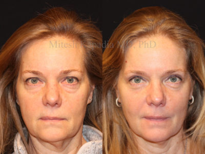 Woman in her mid-50s before and after upper and lower eyelid surgery displaying a natural, refreshed and more youthful appearance
