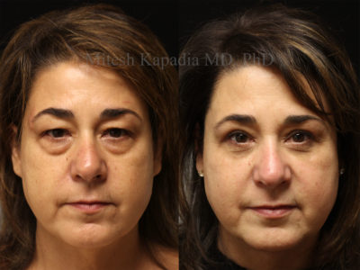 Woman in her mid-50s before and after upper and lower eyelid surgery, displaying a natural, rejuvenated and less tired appearance