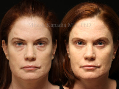 Woman in her early 50s before and after upper and lower eyelid surgery, revealing a more youthful and less tired appearance while still looking natural