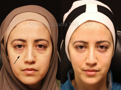 Woman in her mid-30s before and after lower eyelid and midface filler injections, revealing a less tired and refreshed appearance