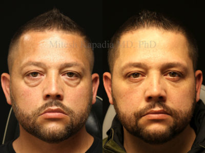 Man in his mid-40s before and after lower eyelid surgery, as well as midface filler injections, revealing a more youthful, refreshed and well rested appearance