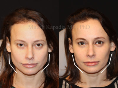 Woman before and after Botox injections to the masseter muscle, giving her a slimmer, more feminine jawline. These injections often produce symptomatic improvement in teeth grinding and clenching, which can often be life changing for patients