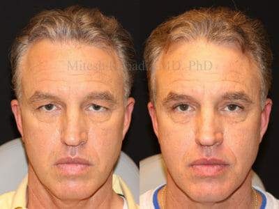 Man in his mid-50s before and after upper blepharoplasty surgery, revealing a more youthful and rejuvenated appearance