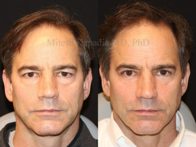 Man in his mid-50s before and after upper and lower blepharoplasty surgery. Two vials of filler were used in the post operative period in the midface area, revealing a rejuvenated, more youthful look