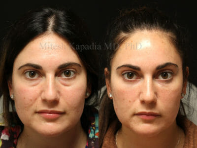Woman in her late 20s before and after lower blepharoplasty surgery with one vial of filler used in the eyelid-cheek junction during the post operative period. She appears refreshed and well rested after her procedures without looking fake or overdone