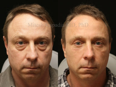 Man in his early 50s before and after upper and lower blepharoplasty surgery with one vial of filler used during the post operative period. This man appears more youthful and rejuvenated after his procedures