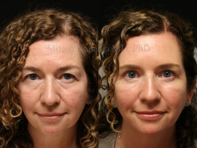 Woman in her late 40s before and after upper and lower blepharoplasty surgery resulting in a rejuvenated and refreshed look