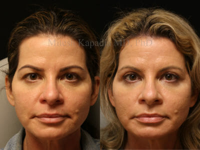 Woman in her late 40s before and after upper blepharoplasty surgery displaying a less tired and rejuvenated look