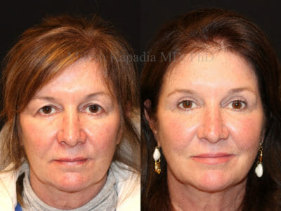 Woman in her late 50s before and after upper blepharoplasty surgery showing a more youthful and rejuvenated appearance after her procedure