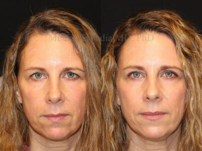 Woman in her early 50s before and after upper blepharoplasty surgery, revealing a more youthful and refreshed appearance