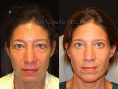 Woman in her mid-40s before and two months after upper and lower blepharoplasty surgery showing a more youthful and rejuvenated result