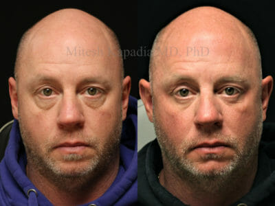 Man in his mid-40s before and two months after lower blepharoplasty surgery. Fillers were used in the midface area during the post operative period. He appears less tired, more youthful and well rested after his procedures
