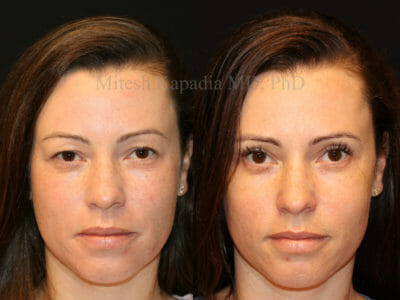 Woman in her late 30s before and three months after upper blepharoplasty surgery displaying a refreshed and less tired look