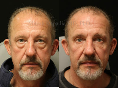 Man in his late 50s before and after upper and lower blepharoplasty surgery, with two vials of filler used in the post operative period. The photos show a more youthful, less tired and still masculine appearance