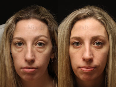 Woman in her mid-30s before and after lower blepharoplasty surgery showing a natural, rejuvenated look
