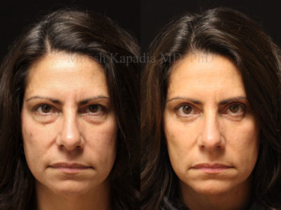 Woman in her early 50s before and after bilateral lower and left side only upper blepharoplasty, displaying a more youthful, refreshed appearance