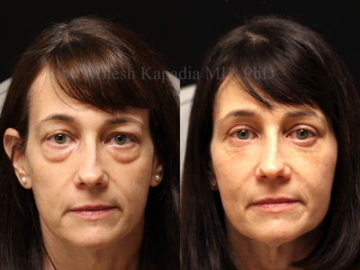 Woman in her late 40s before and after upper and lower blepharoplasty surgery with two vials of filler done during the post operative period to help blend the eyelid-cheek junction. She appears much more youthful, well rested, and rejuvenated.
