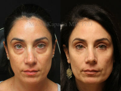 Woman in her late 40s before and one year after lower eyelid surgery displaying a refreshed, well rested appearance