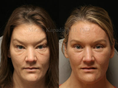 Woman in her mid-40s before and after upper and lower blepharoplasty surgery with full face CO2 laser skin resurfacing. After her procedure, she appears more youthful, less tired, and rejuvenated